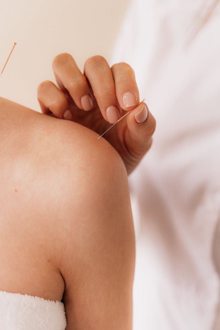 Close-up of acupuncture needle therapy on a patient
